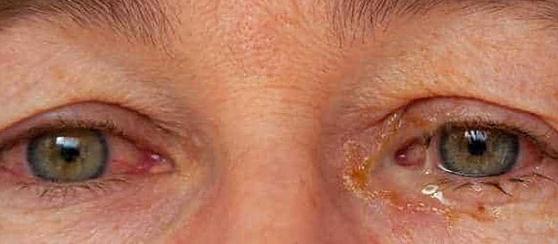 CONJUNCTIVITIS &nbsp; &nbsp; &nbsp; &nbsp; &nbsp; &nbsp;